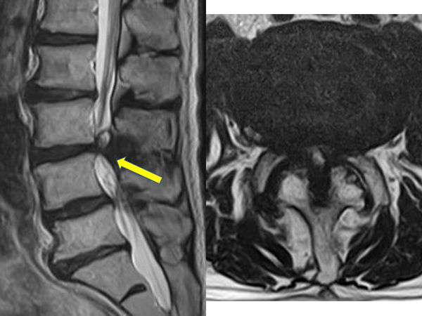 画像：腰部脊柱管狭窄症
