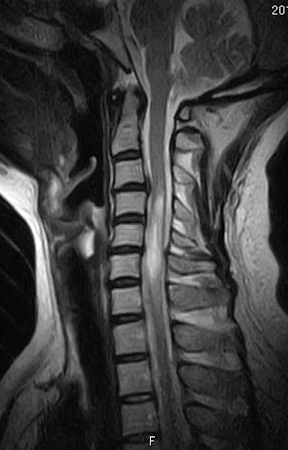 画像：脊椎、脊髄腫瘍