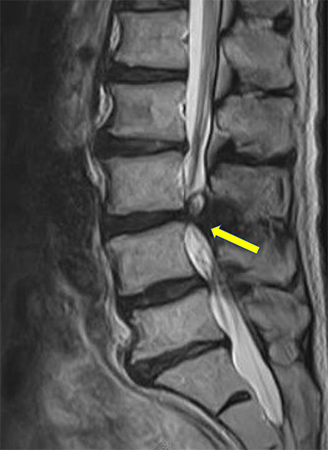 画像：腰部脊柱管狭窄症